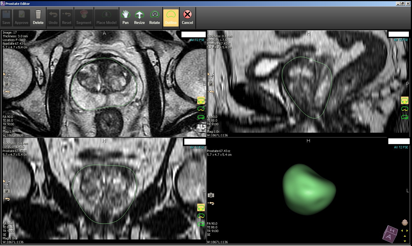 Prostate Fusion