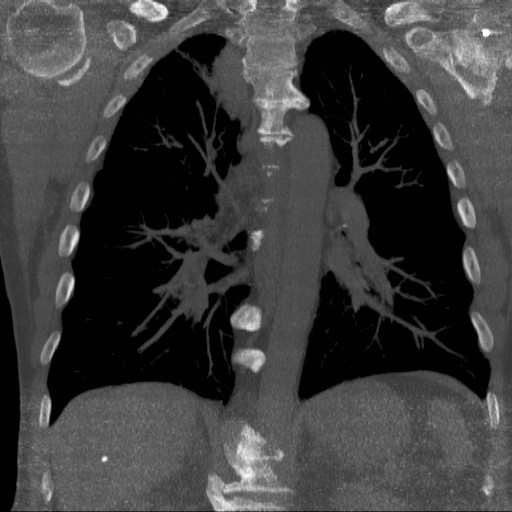 CT Chest Screening