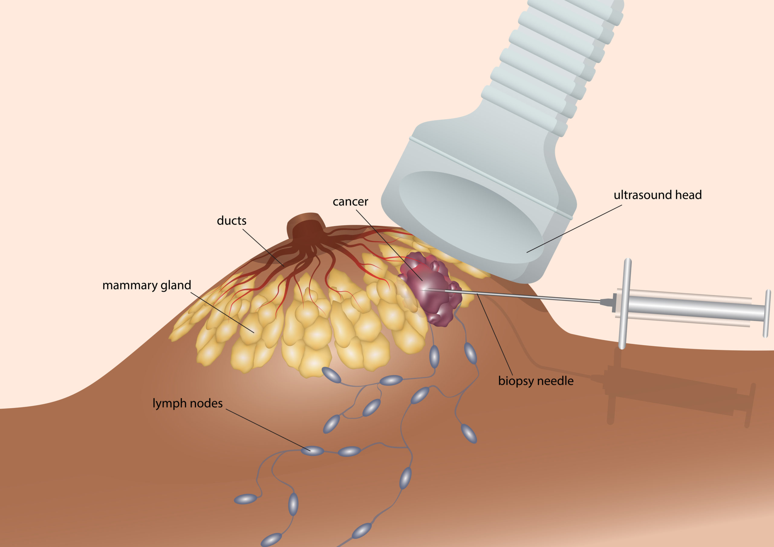 Biopsy The Breast Cancer Cell